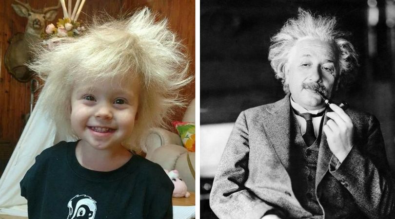 Dziecko z włosami niczym Albert Einstein – żart rodziców czy nietypowa choroba?