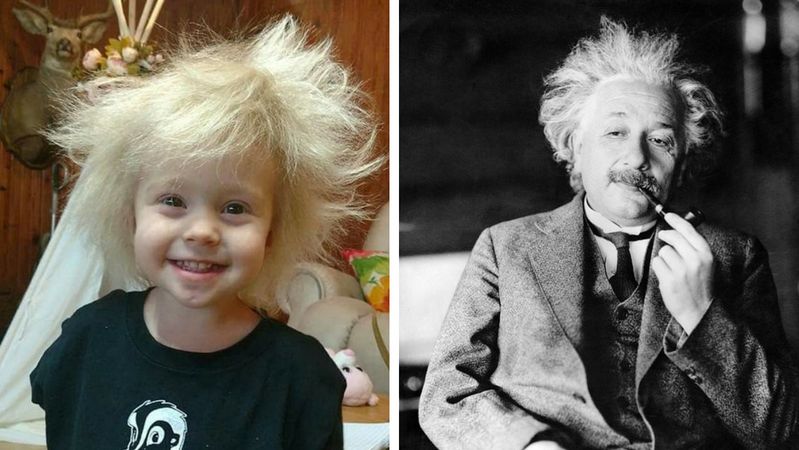 Dziecko z włosami niczym Albert Einstein – żart rodziców czy nietypowa choroba?