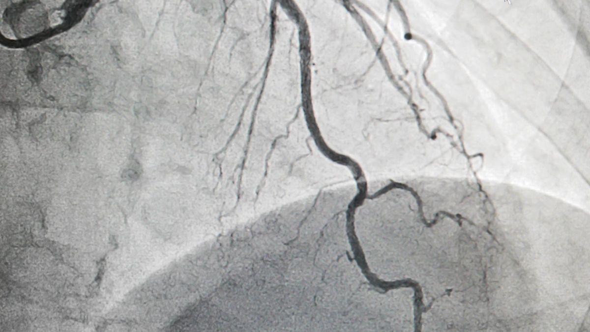 Rocznie w Polsce umiera 350-400 tys. osób. Szacuje się, że nawet 70 proc. zgonów spowodowana jest chorobami układu krążenia.