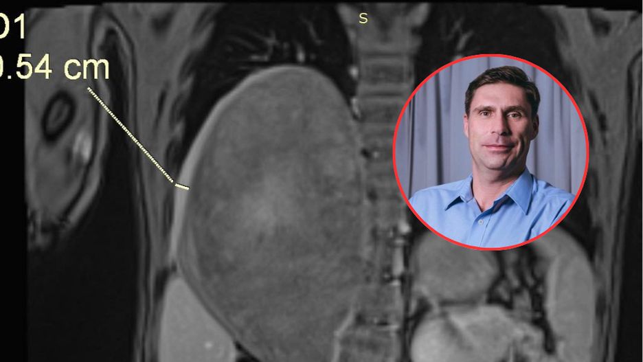 Myśleli, że to zwykła infekcja. W klatce piersiowej 4-latka znajdował się gigantyczny guz