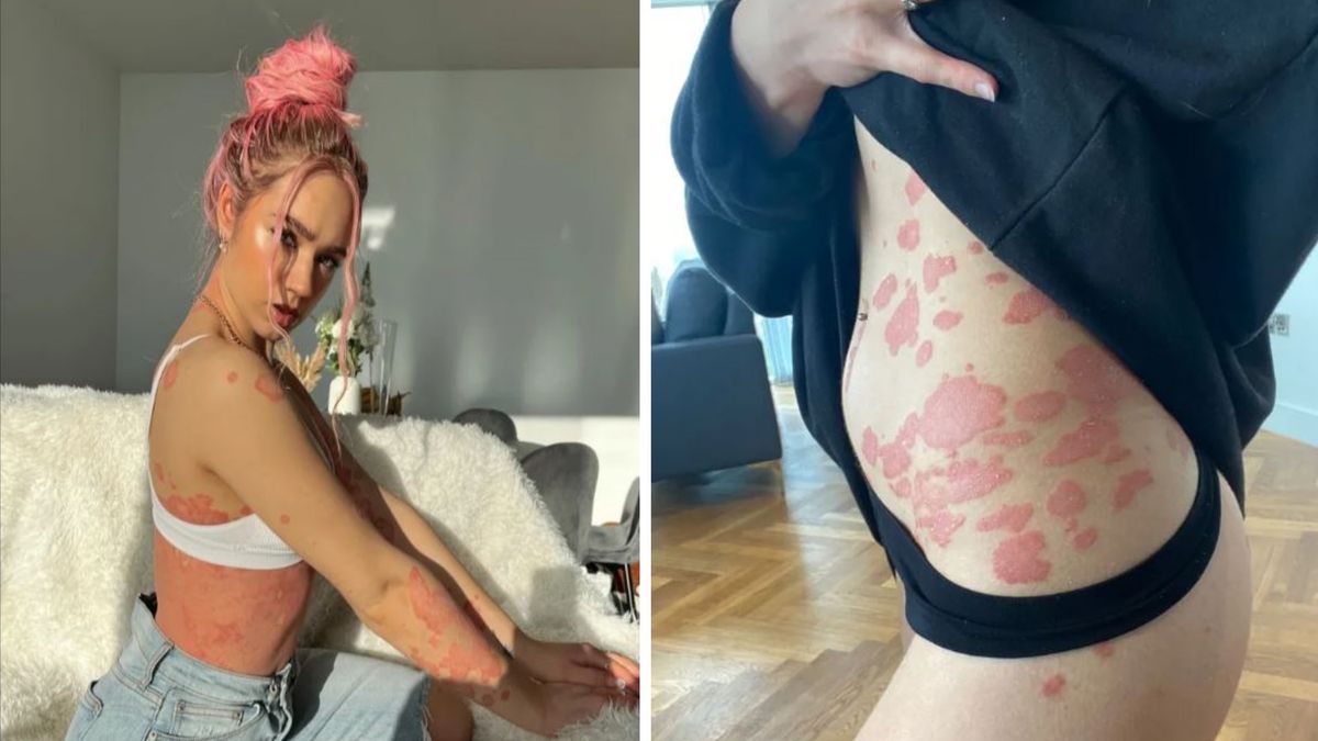 Choruje na łuszczycę. Jej ciało pokryte jest w 80 proc. czerwonymi plamami. "Wszystko w moim życiu kręci się wokół choroby"