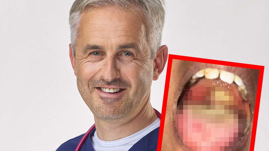 Takie objawy może dawać błonica. W przypadku dzieci warto zwrócić uwagę na gardło