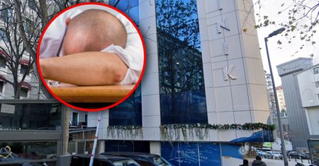 Tragiczny finał przeszczepu włosów w Turcji. "Stan się pogorszył"