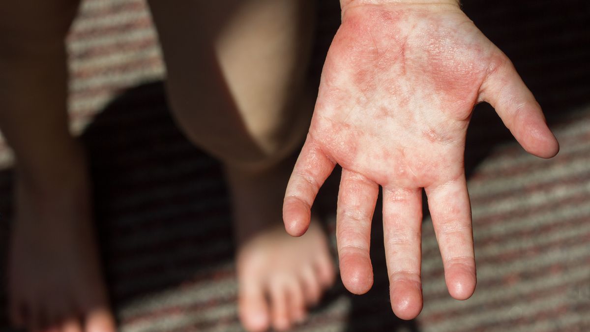 Szkarlatyna inaczej płonica jest chorobą, która dotyczy przede wszystkim dzieci i przenoszona jest drogą kropelkową.