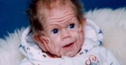 Noworodek o wyglądzie staruszka. Tak wygląda 30 lat później
