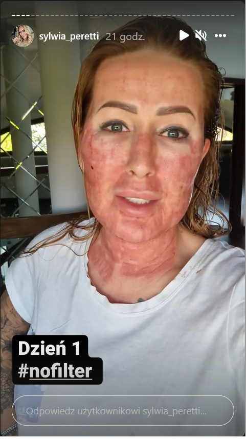 Sylwia Peretti po zabiegu laserowym