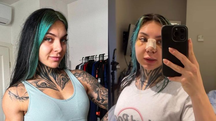 Sheeya zoperowała sobie w Turcji nos i powiększyła piersi