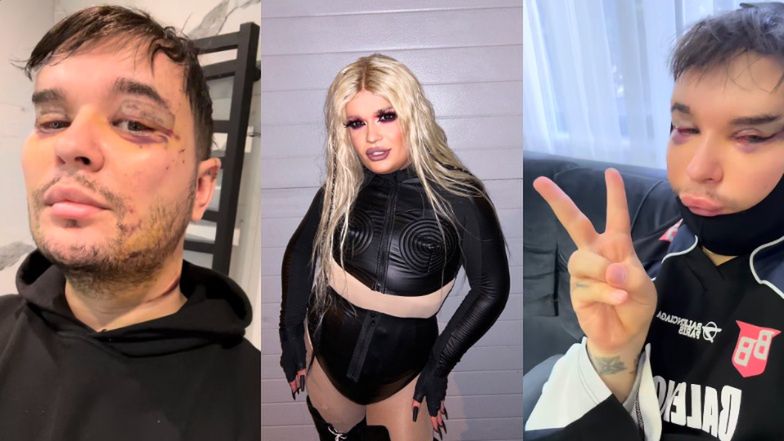 Drag queen Filo relacjonuje operację plastyczną w Turcji