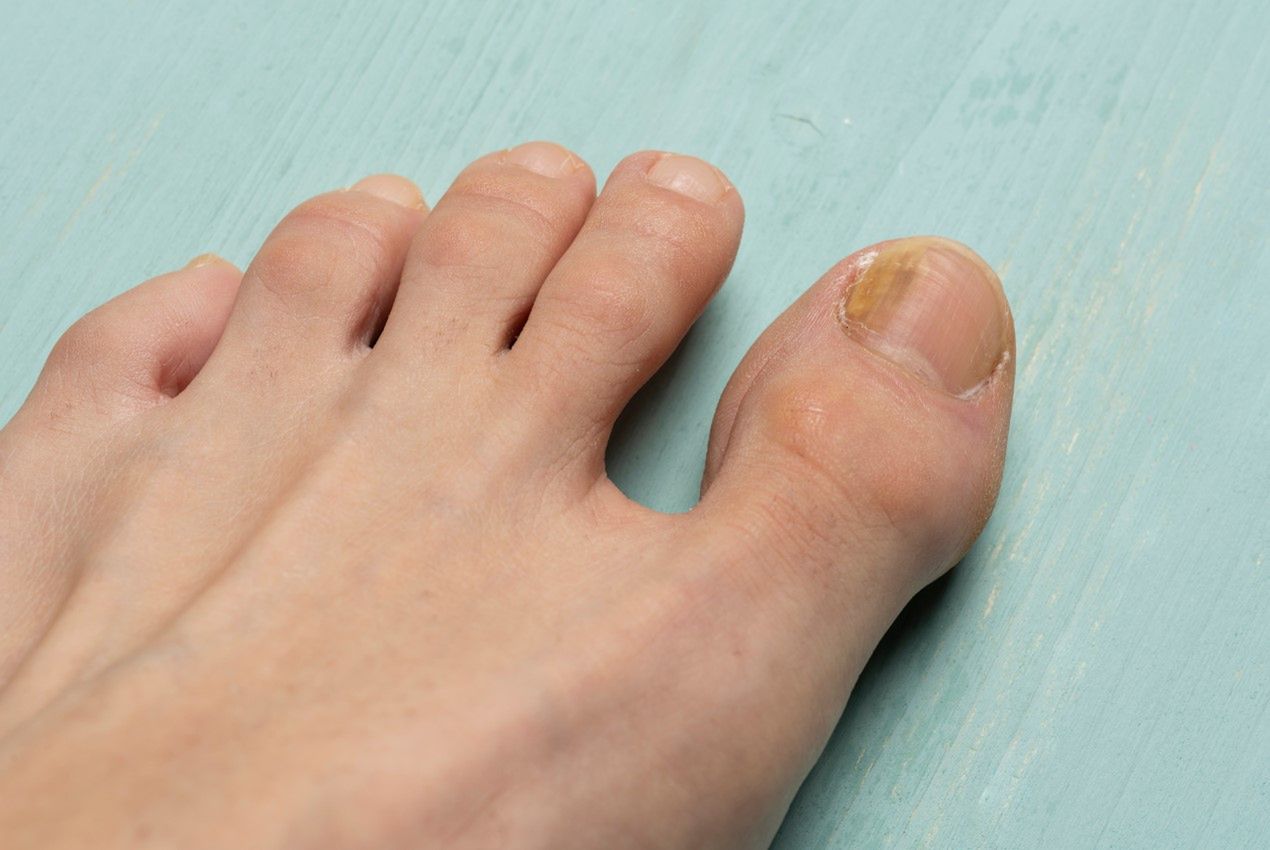 Grzybica – rodzaje, przyczyny, objawy, leczenie