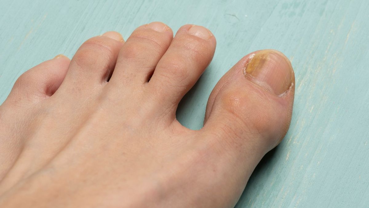 Grzybica to zakaźna choroba, która może objąć tak skórę, jak i paznokcie.