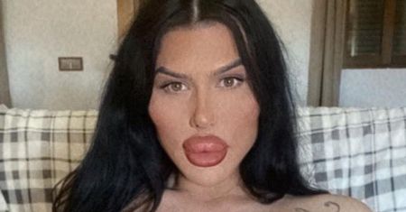 Twierdzi, że ma największe USTA w Wielkiej Brytanii. Lekarze nie chcą jej już przyjmować (FOTO)