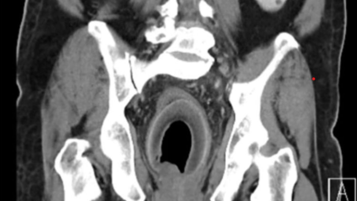 W ciele pacjenta znaleziono ciało obce. Konieczna była operacja