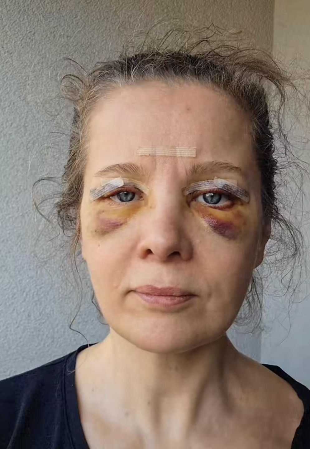 Anna Powierza wycięła nadmiar skóry na powiekach