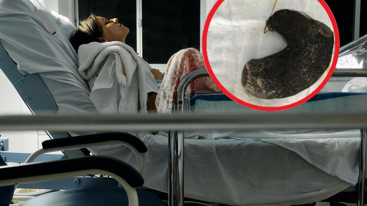 Z żołądka nastolatki usunięto ogromną kulkę włosów