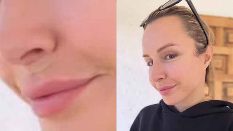 Blanka Lipińska zachwala lifting ust