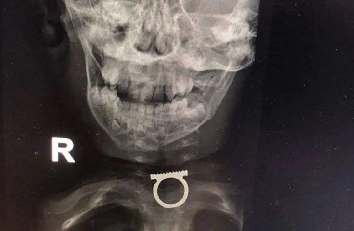 RTG ujawniło, gdzie jest pierścionek