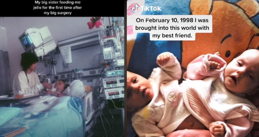 Jedna z bliźniaczek syjamskich zmarła kilka lat po operacji. Jej siostra dzieli się ich historią na TikToku