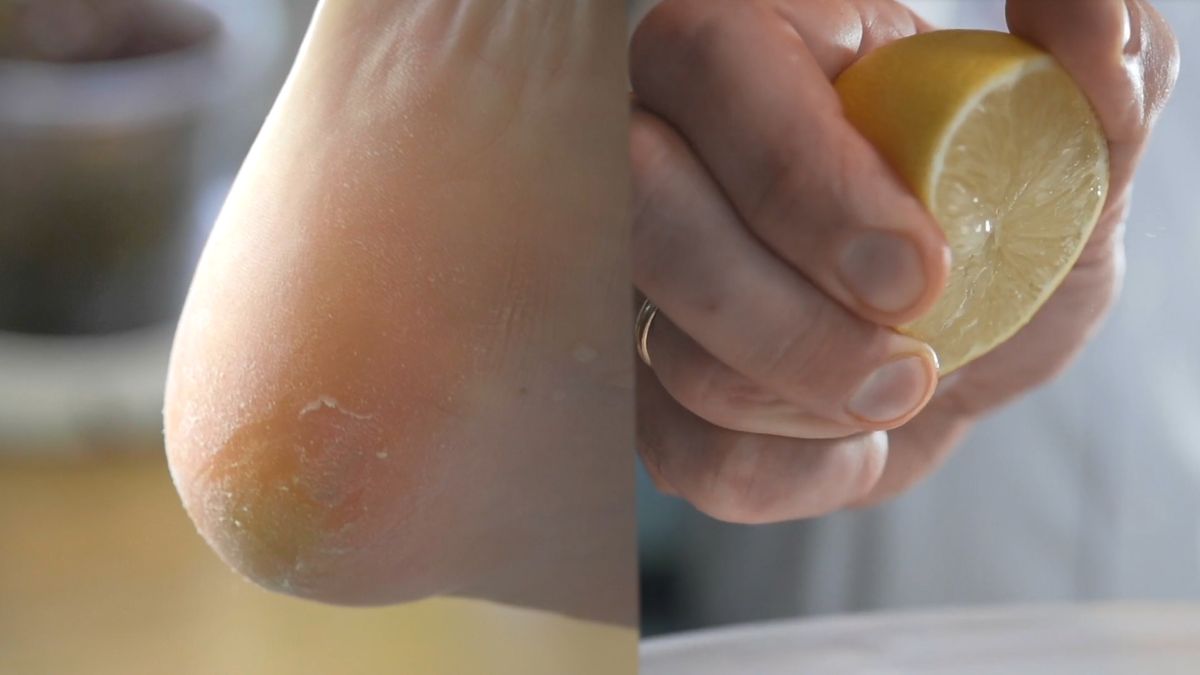 Cytryna dobrze działa na popękane stopy 