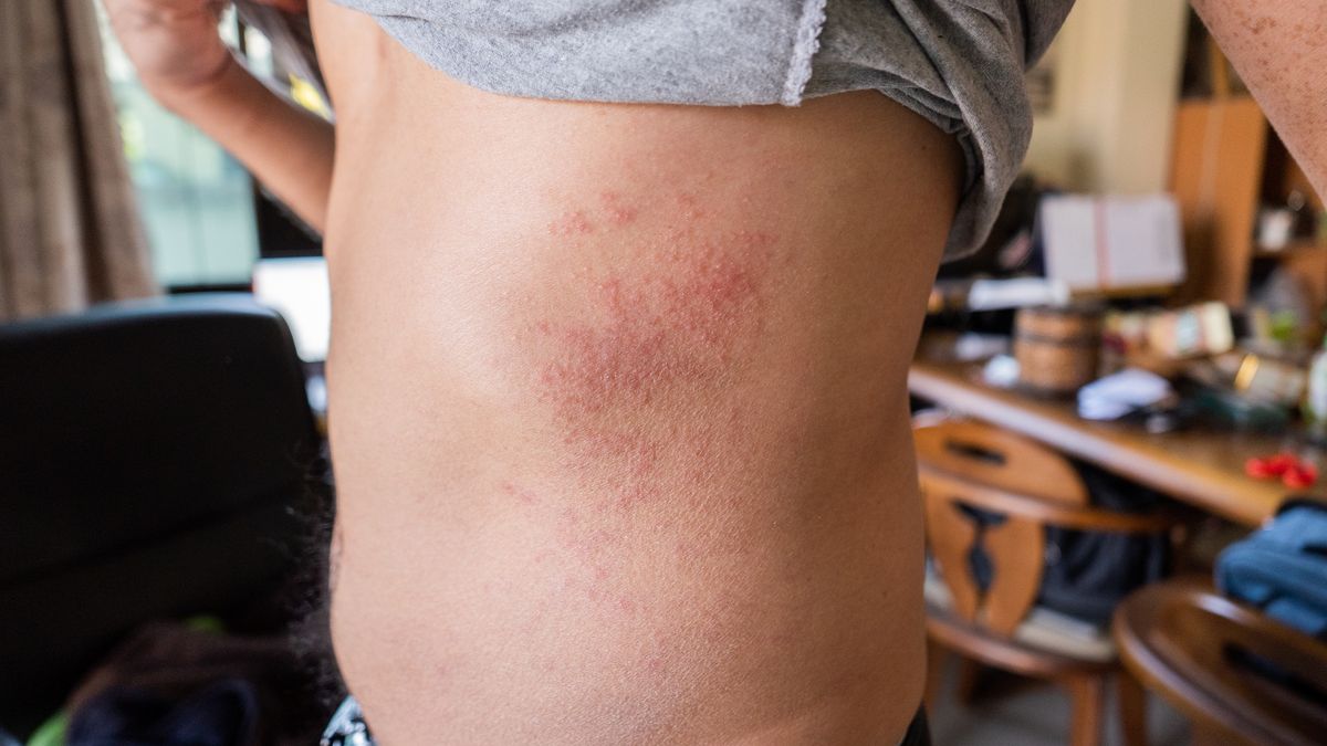 Midsection Of Man With Dermatitis
Woraphon Nusen / EyeEm