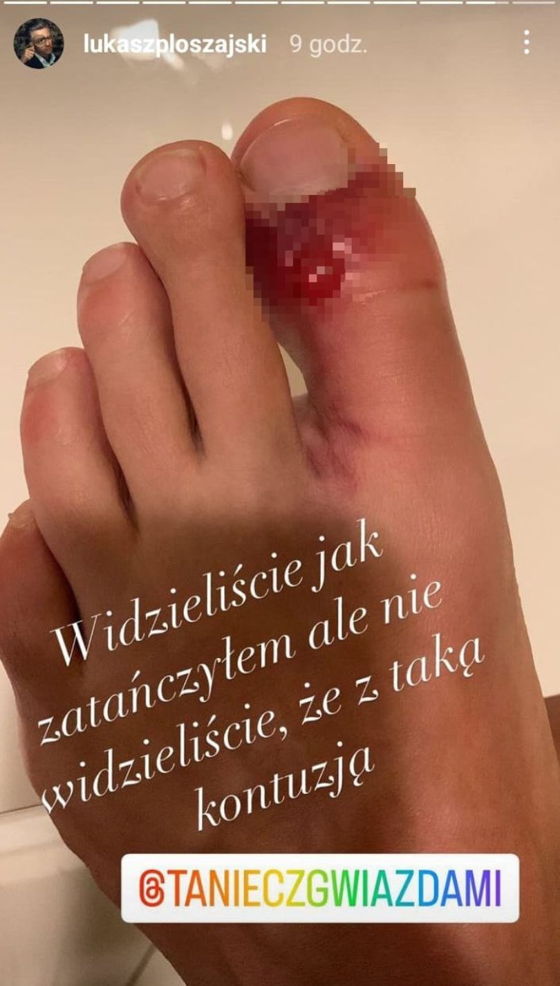 Łukasz Płoszajski pokazuje kontuzję, z którą wystąpił w "Tańcu z gwiazdami"