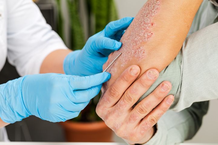 Łuszczyca jest najczęściej rozpoznawaną chorobą dermatologiczną.
