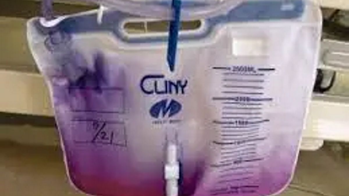 Niezwykły przypadek. 76-latka pacjentka miała fioletowy mocz