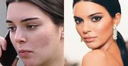 Kendal Jenner twarzą kosmetyków na trądzik. Fani: "Chyba sobie żartujesz! To żałosny płacz dla odrobiny uwagi"