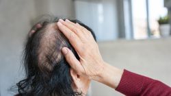 Naturalny słodzik wspomaga leczenie łysienia. Nowa nadzieja dla pacjentów