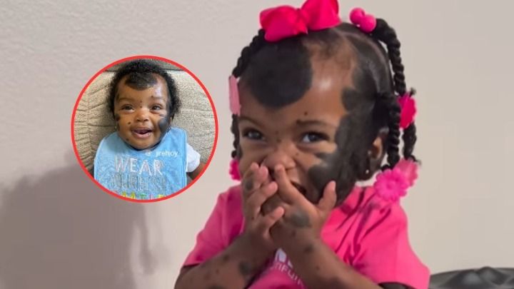 Jej narodziny były szokiem. Tak wygląda teraz dziewczynka-panda