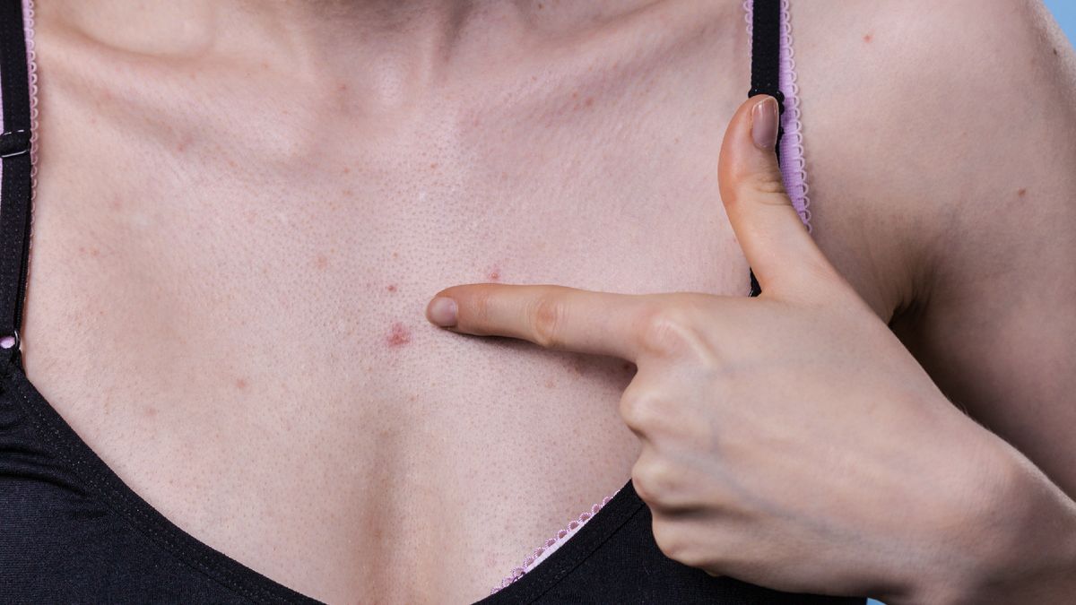 Charakterystyczny objaw na skórze. To znak, że atakuje groźna choroba