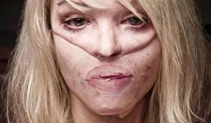 Katie Piper była więziona i oblana kwasem. Jak dziś wygląda jej życie?