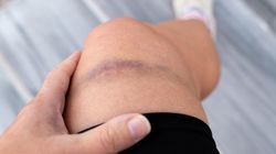 Tak objawia się "choroba królów". Na hemofilię cierpią tysiące Polaków