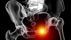 Złamanie kości łonowej - objawy, diagnostyka, leczenie i rehabilitacja