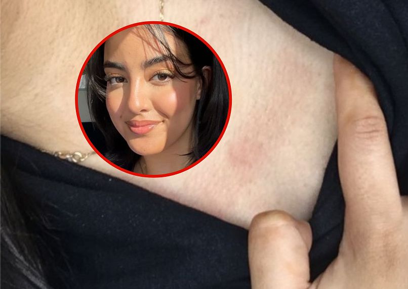 18-latka ciągle ziewała. To był główny objaw raka