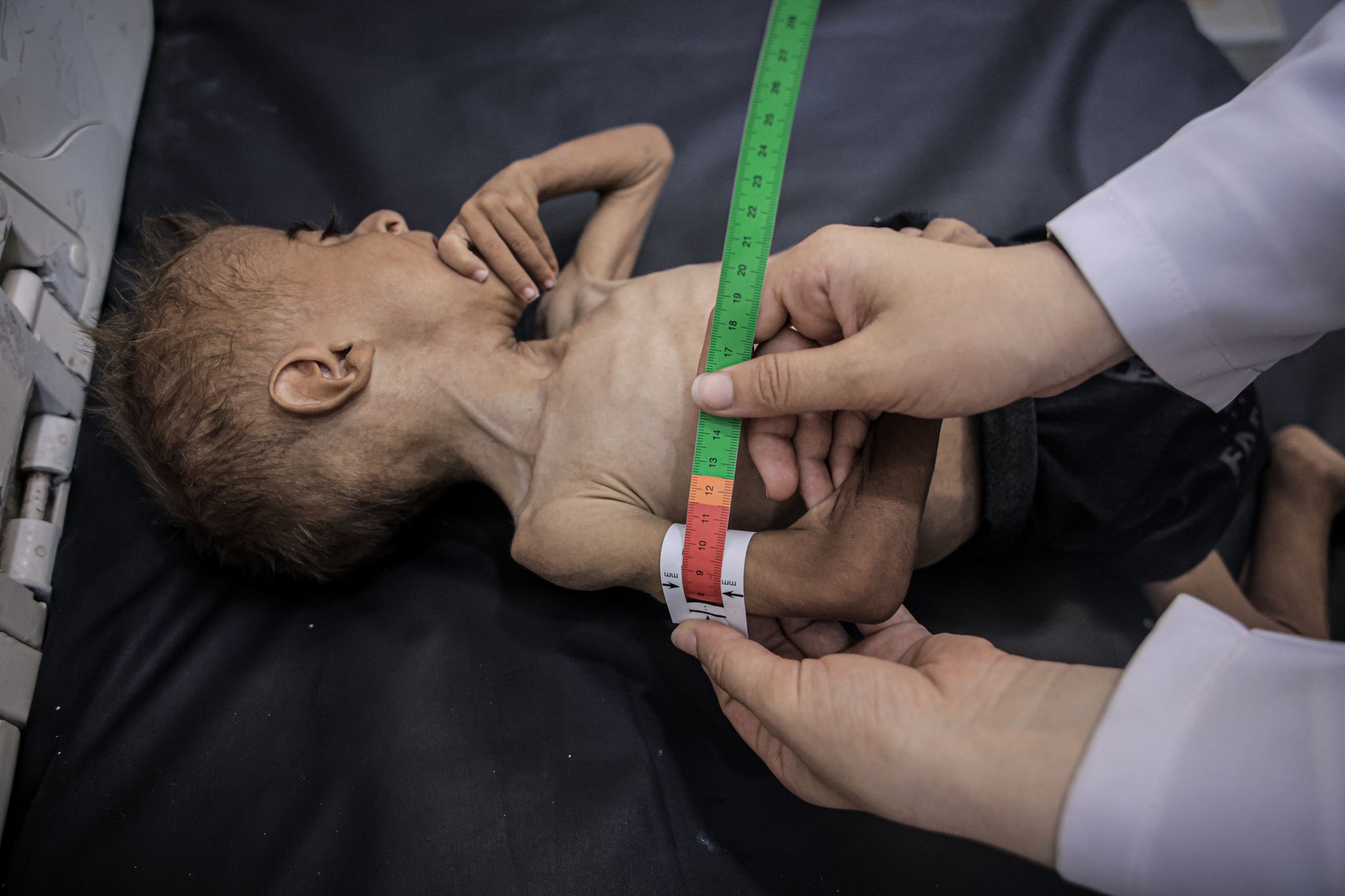 Taśma MUAC wskazuje, że Muhammad cierpi z powodu niedożywienia