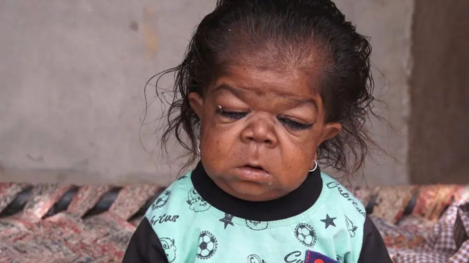 Mężczyzna uwięziony w ciele dziecka. Manpreet Singh urodził się z rzadką wadą genetyczną