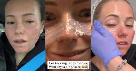 Opuchnięta Agata Rubik cierpi w imię urody po zabiegu laserem: "No dzisiaj to BEZ FILTRA SIĘ NIE DA"