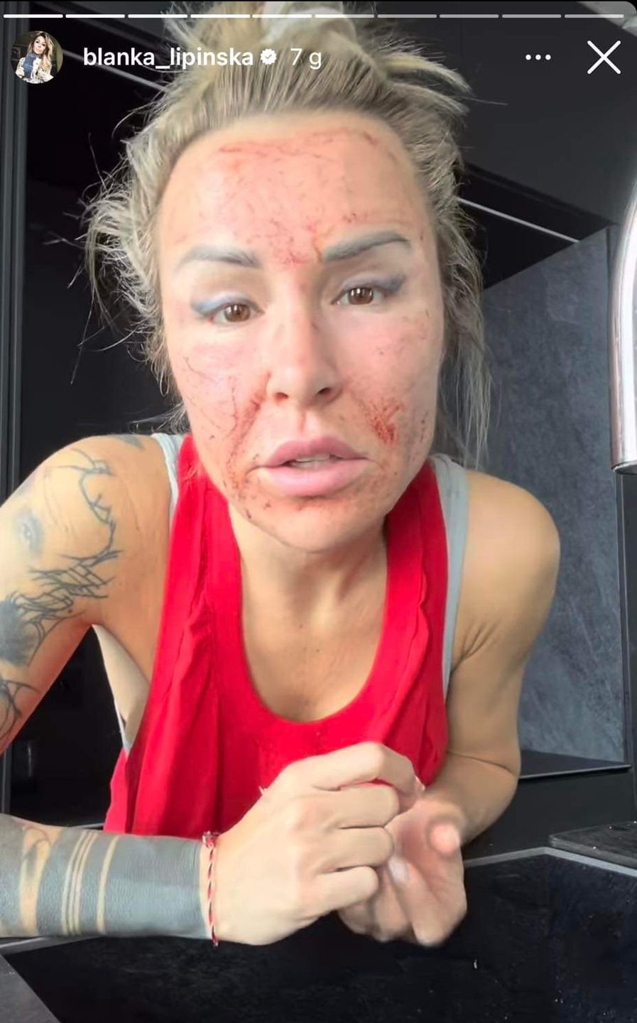 Blanka Lipińska pokazała zakrwawioną twarz