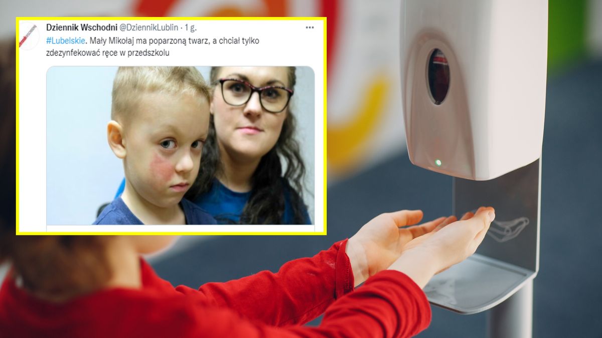 Możliwe, że 5-latek będzie wymagał przeszczepu skóry 