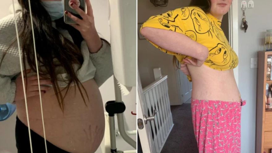 Myśleli, że jest w ciąży. Okazało się, że w okazałym brzuchu znajduje się torbiel