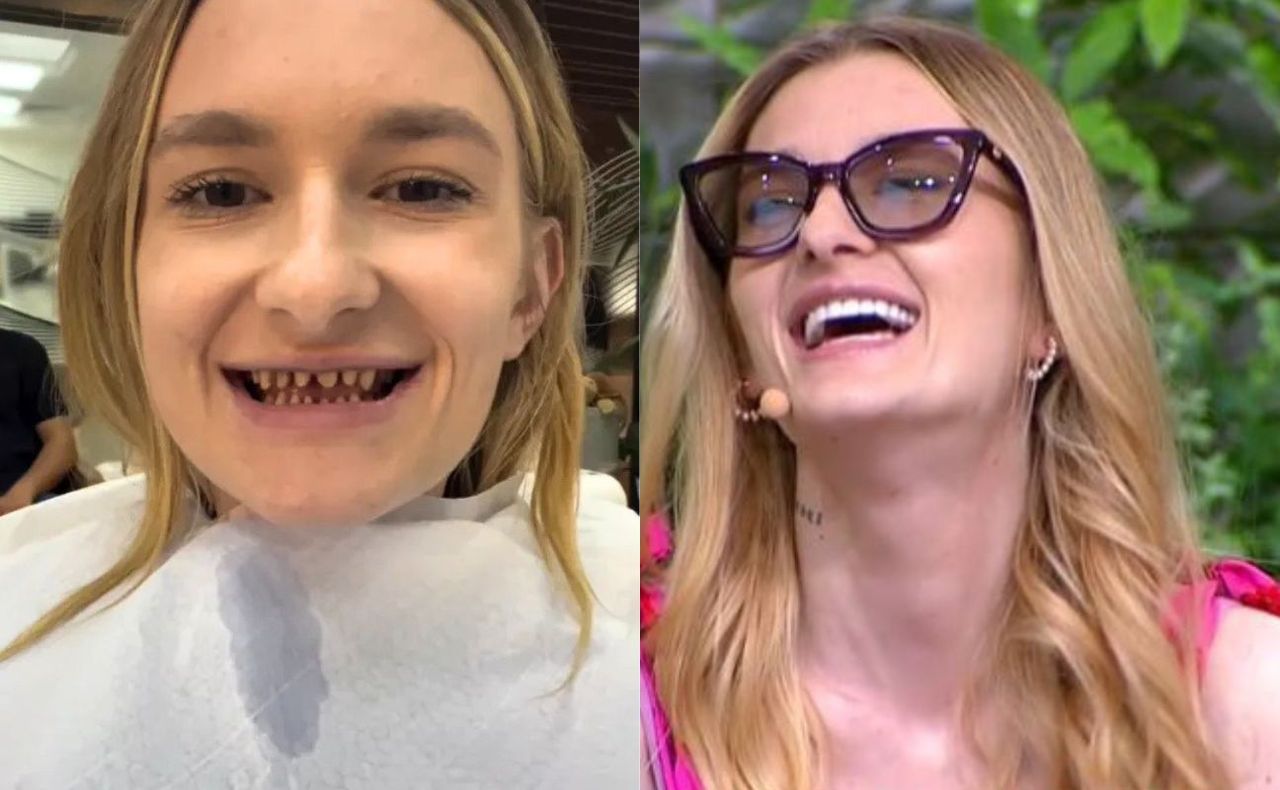 Zrobiła sobie "tureckie zęby". Dentyści łapią się za głowę