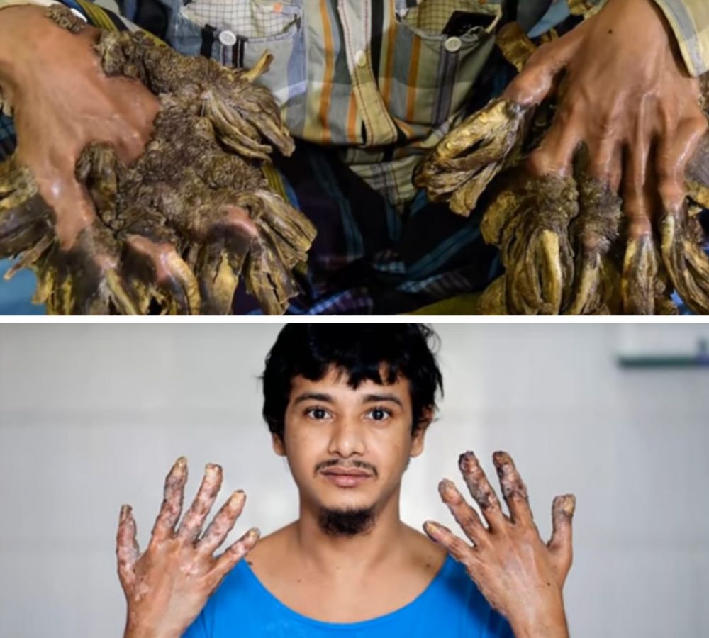 Abul Bajandar - pierwszy na świecie człowiek z chorobą Lewandowsky'ego-Lutza. Przed i po operacji