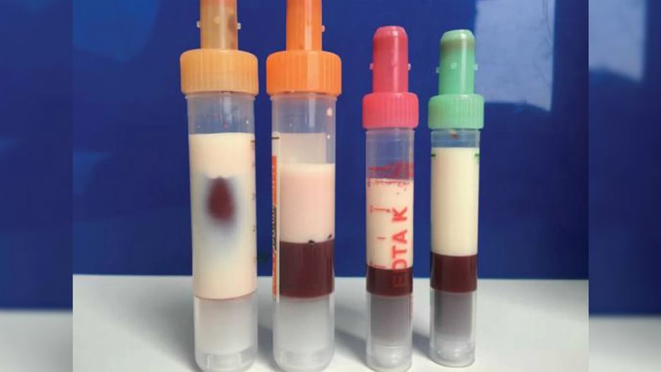 Z powodu wysokiego poziomu trójglicerydów krew pacjenta jednego z niemieckich szpitali stała się biała