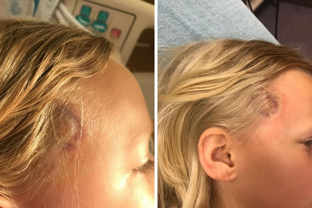 Kolejny nietypowy objaw boreliozy. To zdjęcie pomoże w szybkiej diagnozie