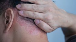 Łuszczyca a orzeczenie o niepełnosprawności. Czy można się o nie ubiegać?