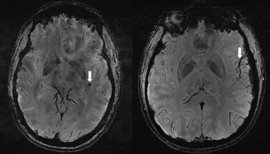 U osób cierpiących na migreny znaleziono zmiany w mózgu. fot. Radiological Society of North America/ Wilson Xu