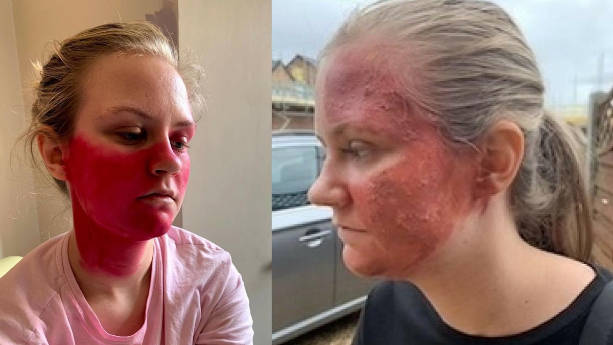 Toczeń sprawił, że Vicky straciła pewność siebie