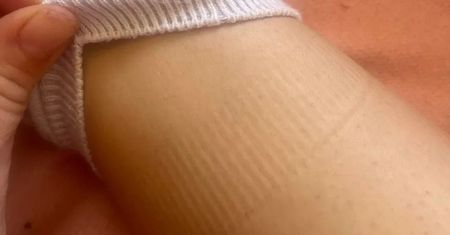 Masz takie ślady po skarpetkach? Nie lekceważ. Chirurg wyjaśnia
