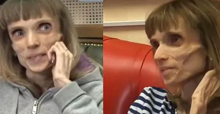 Kiedyś ta kobieta ważyła 17 kilogramów. Oto jak wygląda dzisiaj