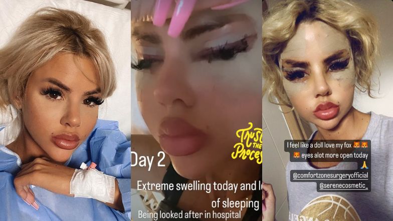 Uczestniczka brytyjskiego "Love Island" chwali się efektami operacji w tureckiej klinice